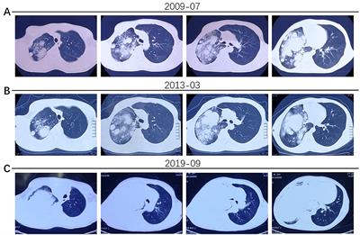 Case Report: Rare Pulmonary Sclerosing Pneumocytoma: Large, Multiple, Metastatic, and Fatal